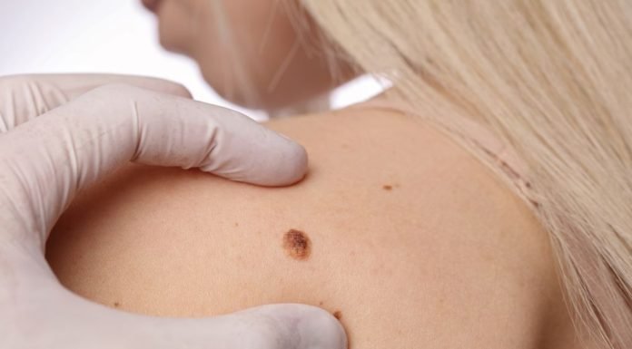 When Should You Go For A Skin Cancer And Mole Check? When Should You Go For A Skin Cancer And Mole Check?