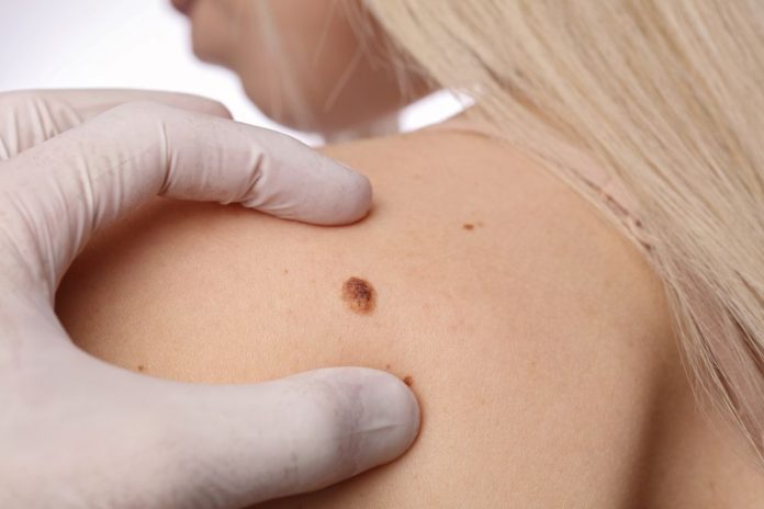 When Should You Go For A Skin Cancer And Mole Check?