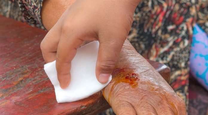 How to Clean and Treat a Wound With Antiseptic Cream Antiseptic Cream