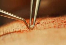 Affordable Hair Transplant in Pune Affordable Hair Transplant in Pune