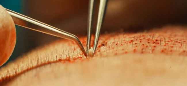 Affordable Hair Transplant in Pune