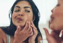 Which Treatment is Best for Pimples? Which Treatment is Best for Pimples