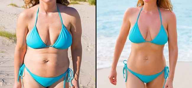 Method For Coolsculpting