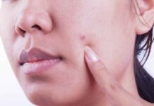 Acne Patch: Things You Need to Know Acne Patch: Things You Need to Know