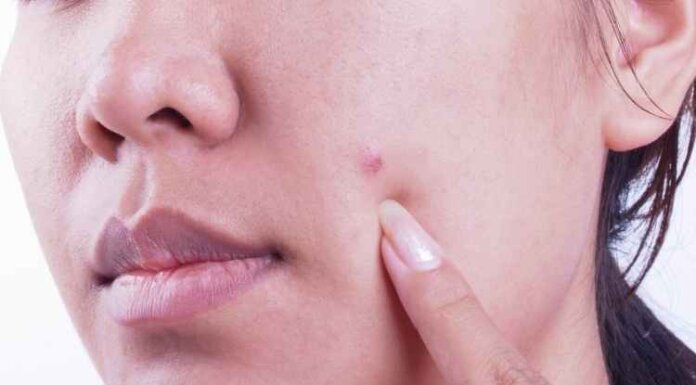 Acne Patch: Things You Need to Know Acne Patch: Things You Need to Know
