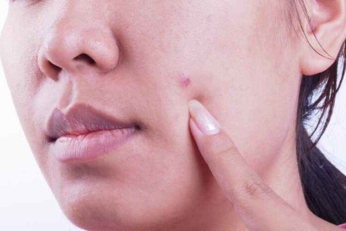 Acne Patch: Things You Need to Know