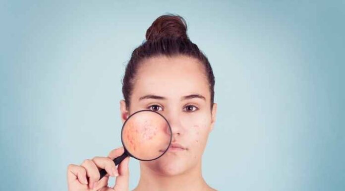 Dealing With Acne: What Not To Do, Preventing Acne And How To Treat Them Dealing With Acne