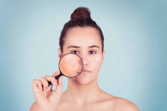 Dealing With Acne Dealing With Acne
