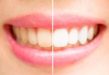 Cosmetic Teeth Whitening: Treatment Options & Benefits Cosmetic Teeth Whitening
