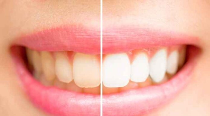 Cosmetic Teeth Whitening: Treatment Options & Benefits Cosmetic Teeth Whitening
