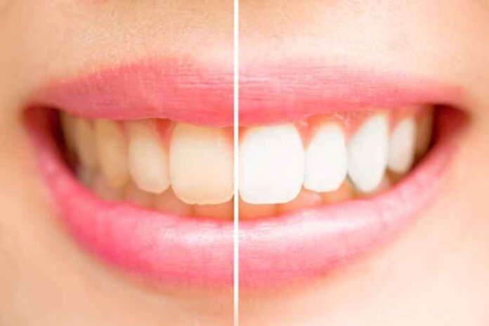 Cosmetic Teeth Whitening