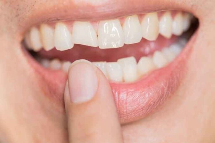 This Is What to Do When You Chip Your Tooth
