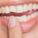 This Is What to Do When You Chip Your Tooth(1)
