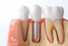 What Are the Different Types of Dental Implants That Exist Today? What Are the Different Types of Dental Implants That Exist Today