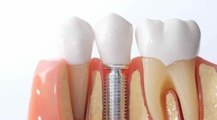 What Are the Different Types of Dental Implants That Exist Today? What Are the Different Types of Dental Implants That Exist Today