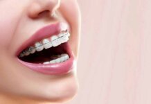 Pros and Cons: 4 Different Types of Braces Explained 4 Different Types of Braces Explained