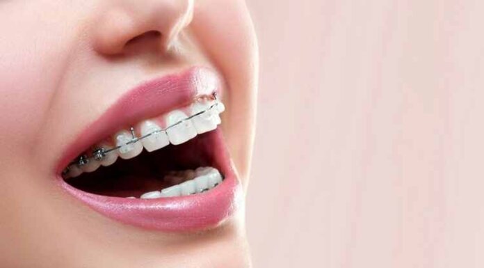 Pros and Cons: 4 Different Types of Braces Explained 4 Different Types of Braces Explained