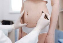 How to Get Rid of Fluid After Liposuction How to Get Rid of Fluid After Liposuction