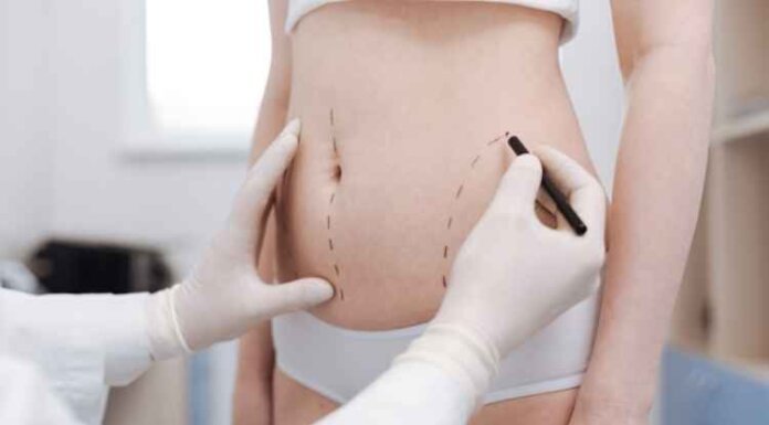 How to Get Rid of Fluid After Liposuction How to Get Rid of Fluid After Liposuction
