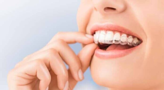 How Much Does Invisalign Cost on Average? A Basic Guide How Much Does Invisalign Cost on Average