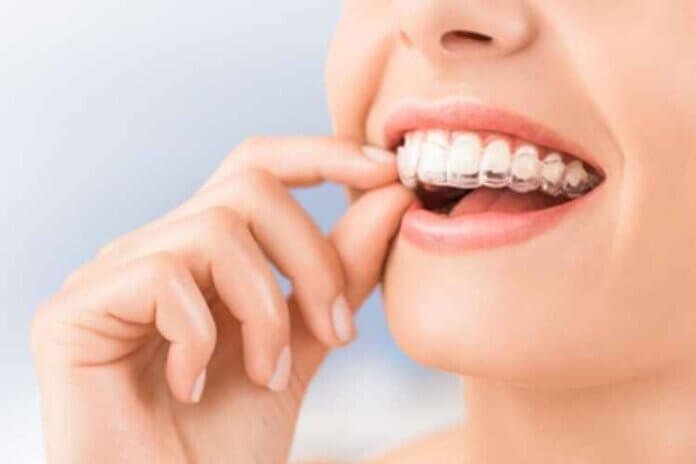 How Much Does Invisalign Cost on Average