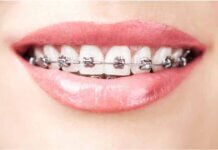 Teeth Straightening: A Look at Your Dental Options Teeth Straightening: A Look at Your Dental Options