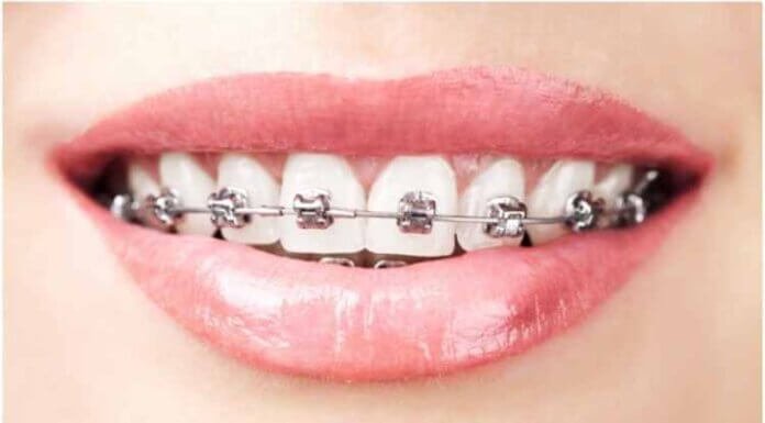 Teeth Straightening: A Look at Your Dental Options Teeth Straightening: A Look at Your Dental Options