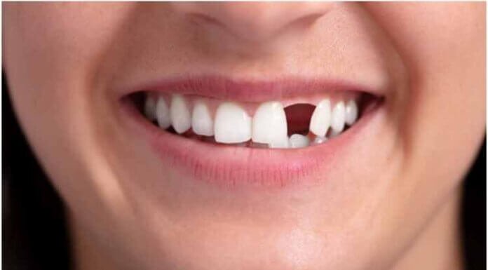 What Can You Do About Missing Teeth? A Quick Guide What Can You Do About Missing Teeth? A Quick Guide
