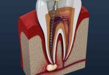 What Is the Average Root Canal Recovery Time? What Is the Average Root Canal Recovery Time?