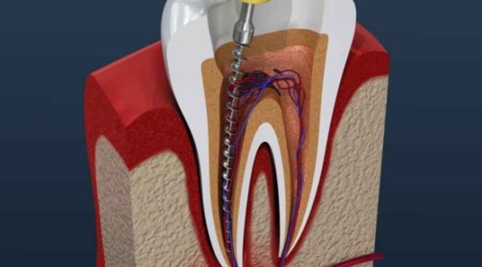 What Is the Average Root Canal Recovery Time? What Is the Average Root Canal Recovery Time?