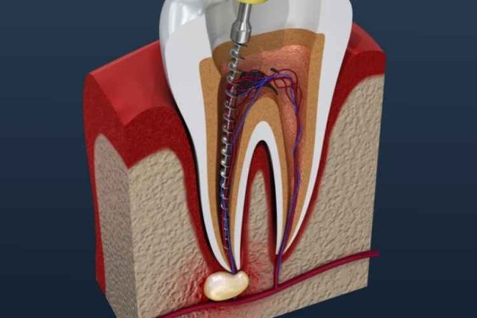 What Is the Average Root Canal Recovery Time?
