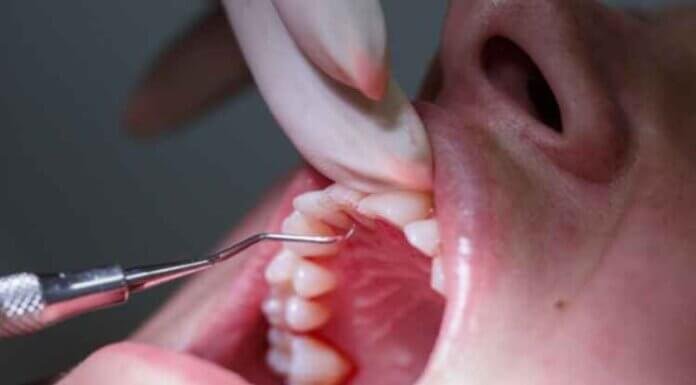 How To Prevent Gum Disease How To Prevent Gum Disease